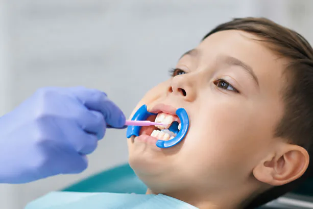 Dental sealants applied to teeth at Woolbert Dental